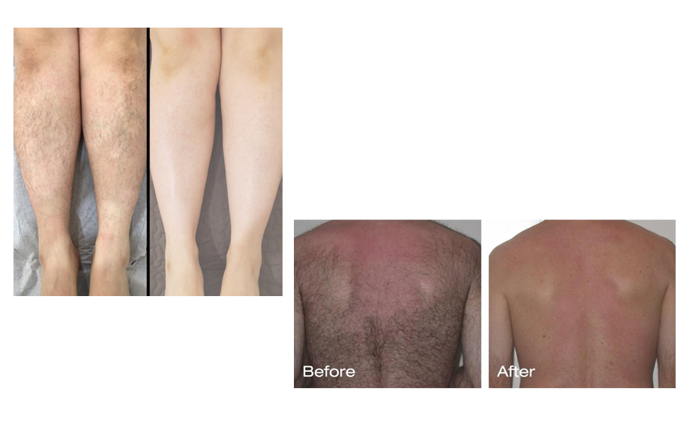 Sugar Wax hair removal: Before and After