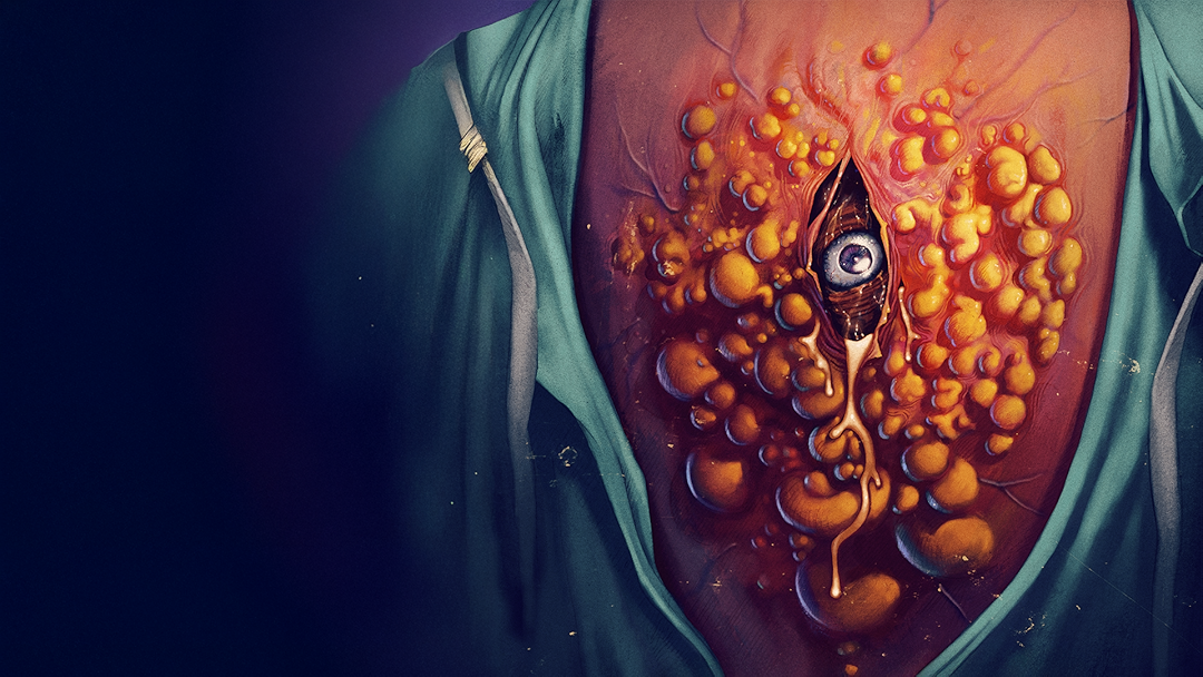Cyst